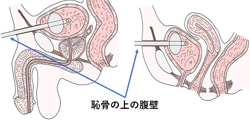膀胱ろう（左：男性，右：女性）