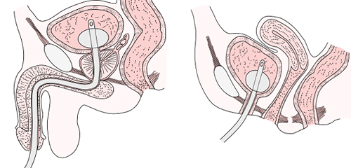尿道留置カテーテル（左：男性，右：女性）