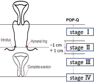 POP-Q stage分類（最下端の部位で評価）