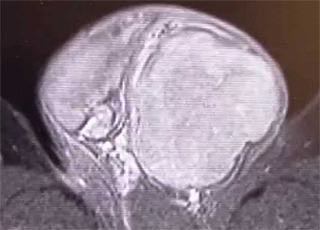 MRI（左精巣腫瘍）