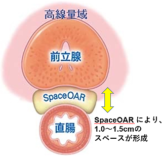 SpaceOAR<sup>®</sup>システム留置あり