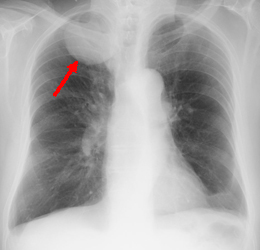 胸部X線写真