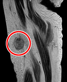 ふとももにできた2cm大の悪性腫瘍（→）のMRI画像